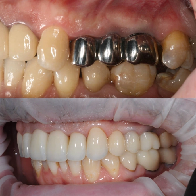 Замена металлических коронок на эстетичные