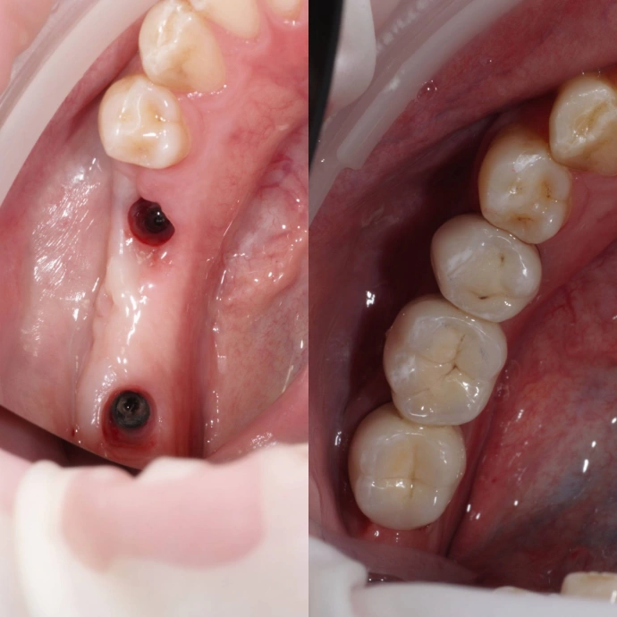Керамический мост с опорой на имплантат